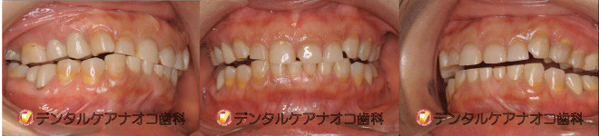 ブラキシズム